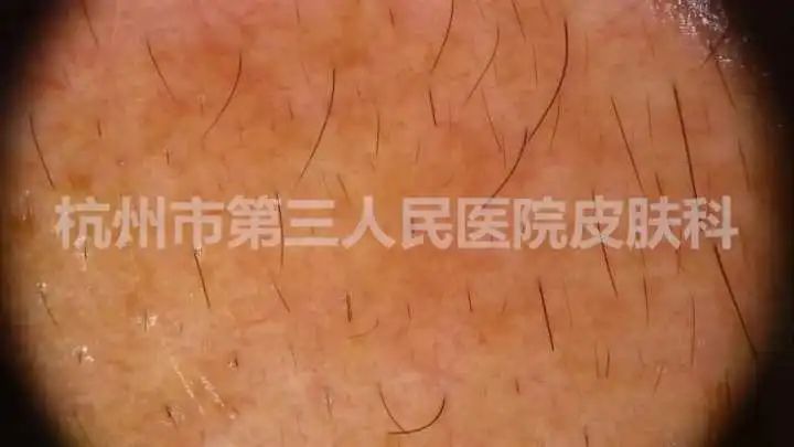 “我竟有黄褐斑？”拿到报告单后，年轻小伙愣在原地：这不是女人才长的吗？