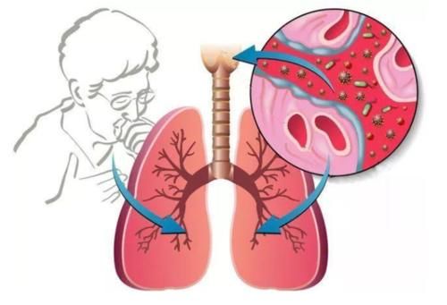 二手烟|查出肺结节该怎么办？呼吸科医生：做好“3忌3吃”，结节慢慢消