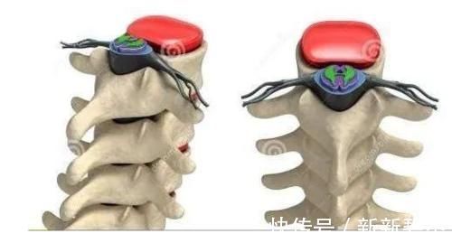 竖毛肌|颈椎,为何为“百病之源”!颈椎病分10级,超过2级就要注意了