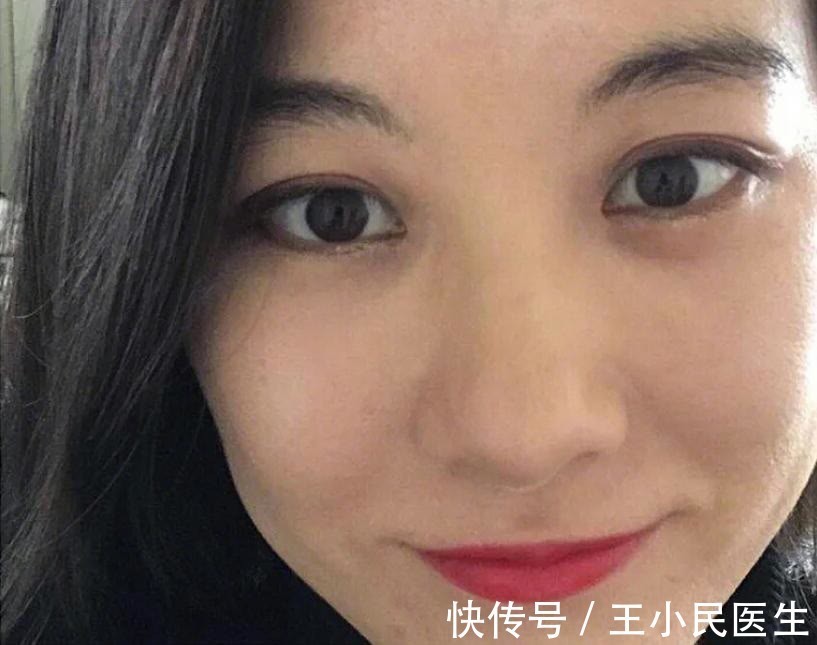 王小民 王小民教授：很多人年纪轻轻就有了眼袋，该怎么办？
