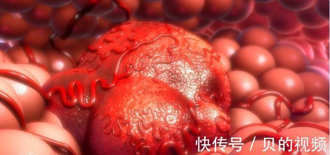 肿瘤病毒|这4个症状,超过3个宫颈癌已不是早期,做好1件事,宫颈癌走远远