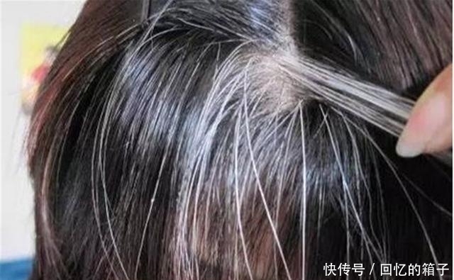 毛囊中|白头发越拔越多?可能和你想的不一样,做好3件事,黑发长出来