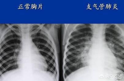 怎么判断孩子是感冒还是肺炎?