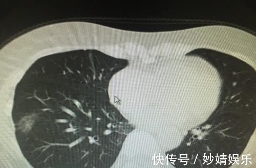 肺结节|如果手部出现这些问题,不是关节炎,或是肺结节发展了,了解一下