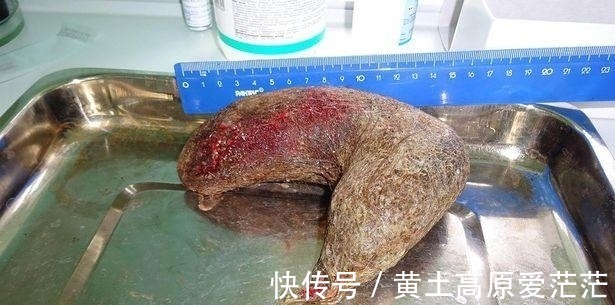 医院|俄罗斯16岁女孩胃不适送医院，手术后取出一大团头发，重达一斤！