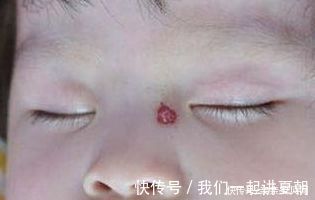 怀孕期间|不想宝宝长胎记?妈妈怀孕期间要尽量避免这4件事