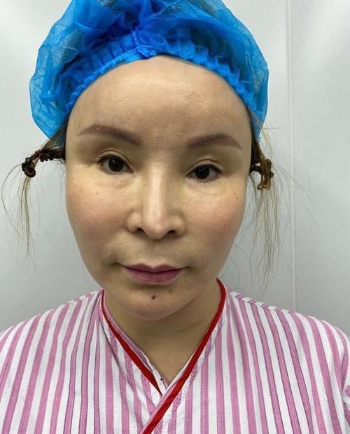 不到50岁就老成大妈？小拉皮术后6个月轻松实现逆生长！
