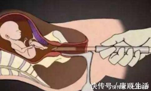 堕胎史|孕妈做“引产”手术,腹中的胎儿会有感觉么看完忍不住心疼