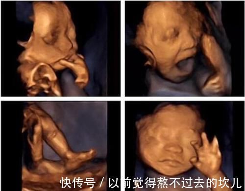 上唇腭裂|孕期胎儿频繁好动,孕妈以为孩子很健康,产检后医生:流产吧