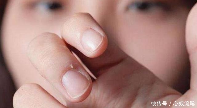 宝宝|提醒孩子有这几种小毛病,是严重缺锌了!家长要长点心!