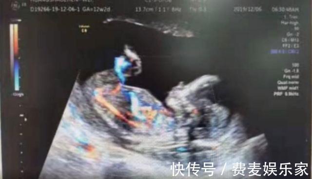 患者|41岁孕妈,怀孕4个月,医生检查找不到胎儿,子宫是空的