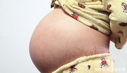 妊娠纹|孕期常出现3种情况，是“好孕”的特征，你中了几个？