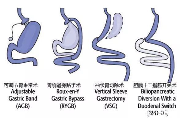 附属第一医院|29岁女生被明星“安利”切胃手术,减重80斤,胃“破”了一个洞