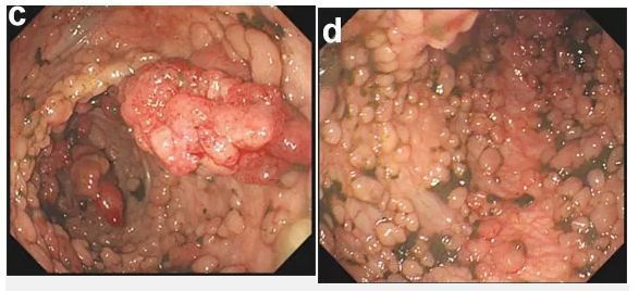 遗传性|这些人,更要进行结直肠癌筛查...甚至10岁就开始