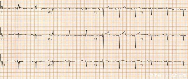  临床资料|心电图读图每日一练，提高诊断水平，第3题（含第2题答案）