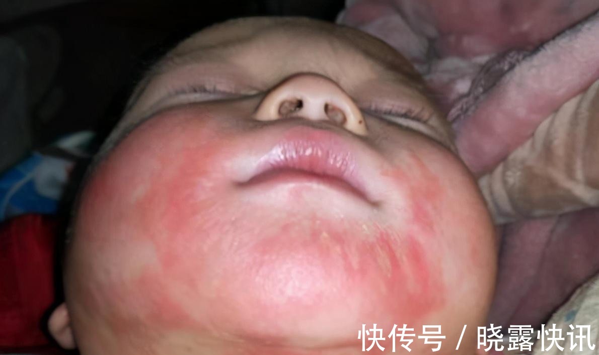 过敏性|儿科医生建议最好别给宝宝吃鸡蛋羹,还在喂的家长,需要注意