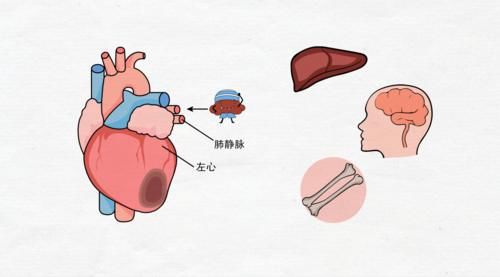 肺癌是如何转移的？