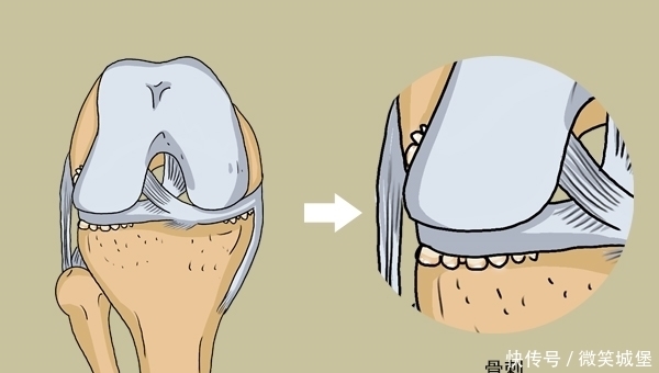查出高血脂后，坚持日行万步，18年后，身体怎么样了？