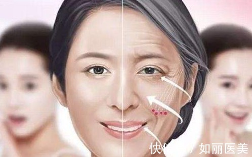 双保险 拉皮手术为什么要植入线或者提拉带?和线雕有什么区别?