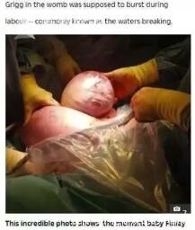 未婚夫|医生从妈妈肚子里取出一个肉球!网友:这是哪吒啊