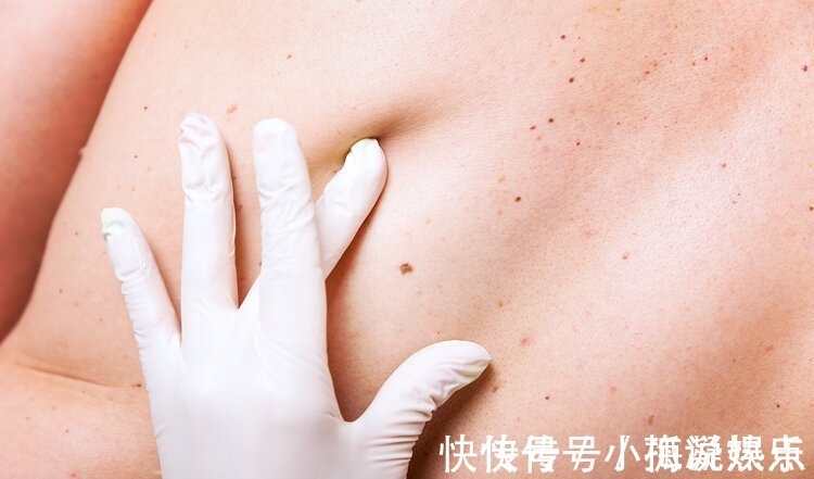 肝病|重视:除了皮肤小红点,身体出现4个异常,可能是肝硬化“敲门”