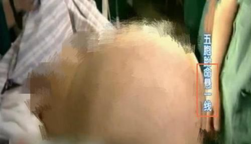 过后|国内首例全部存活五胞胎,18年过后家庭现状如何令人一言难尽