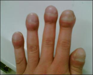 匙状甲|宝宝指甲中,隐藏着哪些关于健康的小秘密