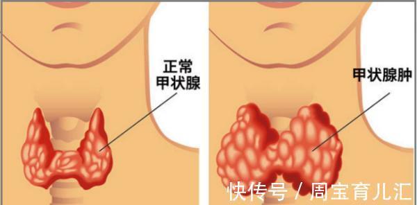 芦根|甲状腺结节并非无声无息,劝告,3个症状出现,需多注意