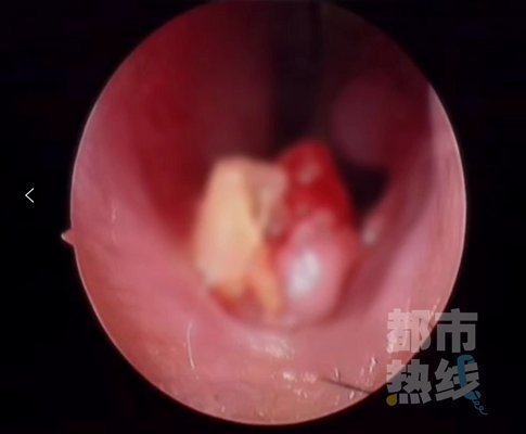 王延辉|一6岁女童鼻子里“长牙”,取出后发现竟是三年前失踪的门牙