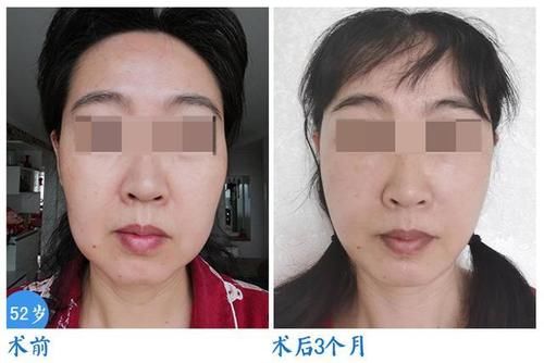 手术 拉皮手术只能维持3、5年？恢复期或许有些痛苦，医生有话说