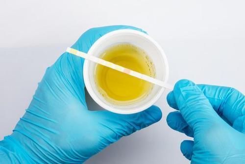 蛋白尿|上厕所时，尿液泡沫多，是蛋白尿，肾功不全吗？别傻傻的不懂