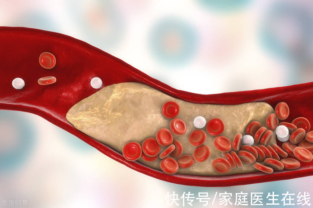 血管壁|血管变硬有多可怕？不仅如此，这2种血管问题也要命
