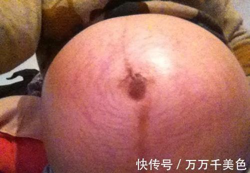 肚子|孕妇肚子上有条黑线,是什么原因呢?需要祛除么?