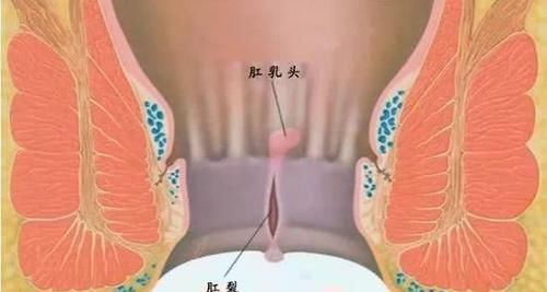 肛裂没有疼痛感..
