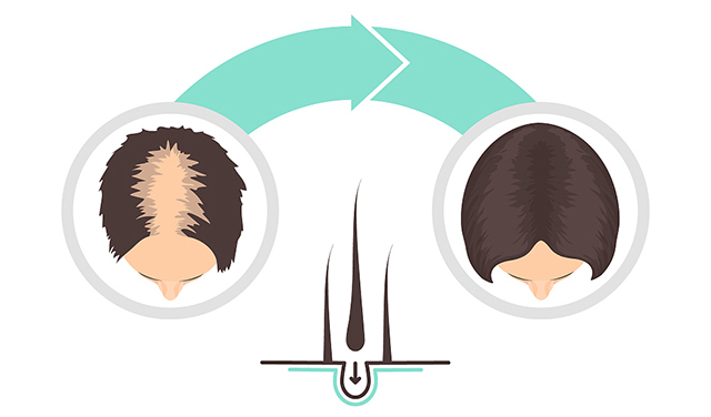 头发稀少怎么办,这个方法适合你!