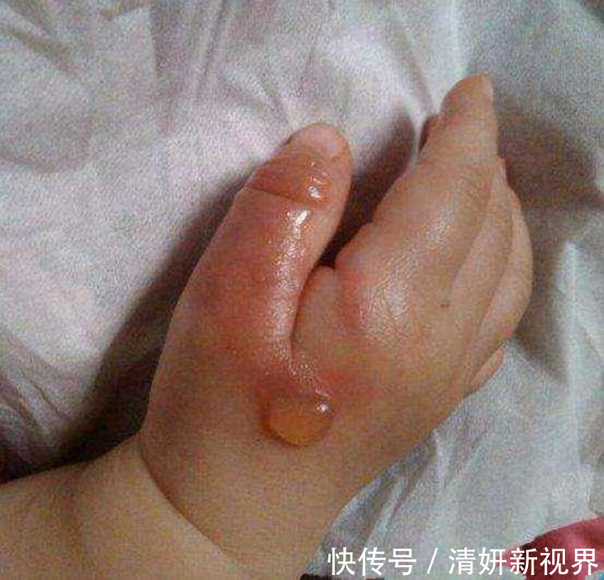 称赞|两岁女儿不小心被开水烫伤,孩子爸的做法令医生称赞简单又专业