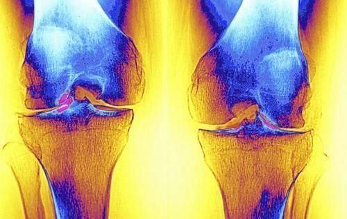 小米|医生提示:想要预防骨质疏松,这“2黑”尽量少吃,或利于养骨