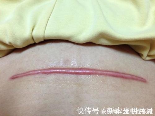 剖腹产|剖腹产的5个隐形后遗症,在生二胎时才会现形,准妈妈要谨慎考虑