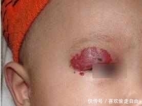 太田母斑|以为宝宝的前额是胎记,但是医生诊断后妈妈后傻眼了