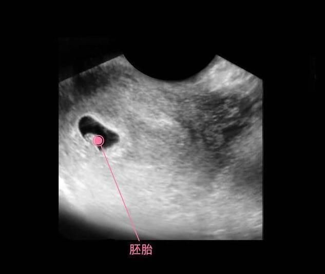 性别|胎儿从卵泡到性别形成,17张图片清晰诠释,男宝女宝看得很清楚
