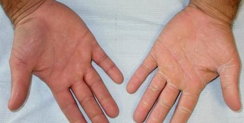 血海|女性贫血不用慌，身上就有“补血药”，多按一穴位补充气血气色好