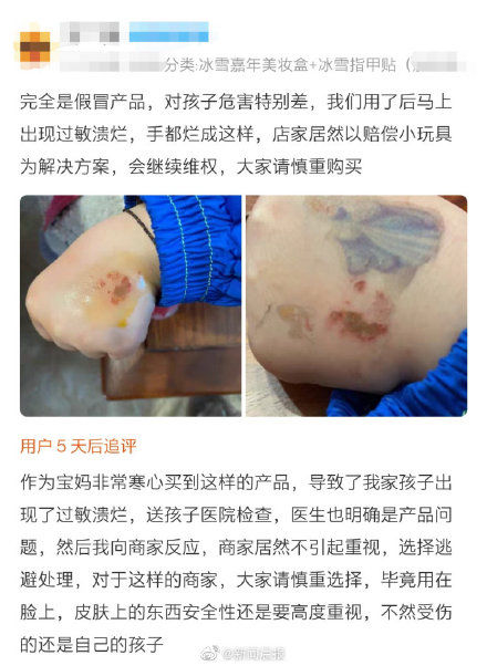 儿童彩妆使用后皮肤过敏溃烂