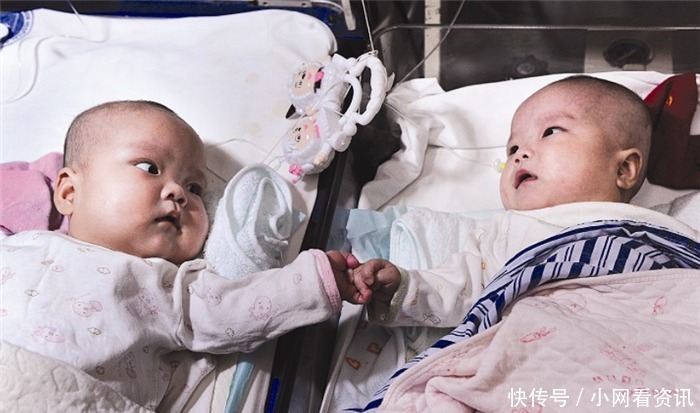 妹妹张珑|连体姐妹做分离手术时,共有器官给了姐姐,10年后妹妹怎么样了