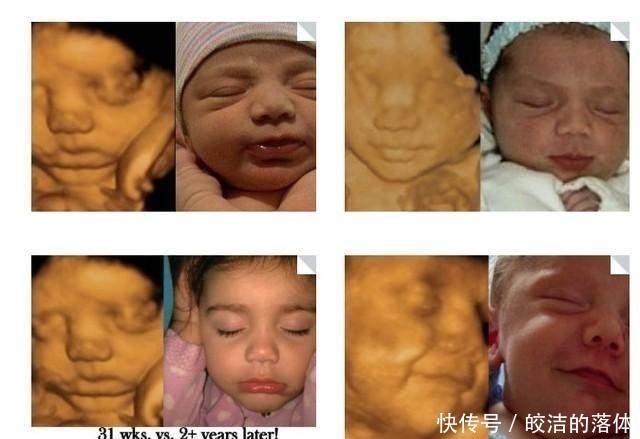 液体|做B超前涂的那层黏黏的、凉凉的液体是什么?做完要马上洗掉吗?