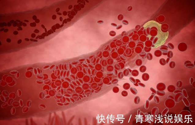 冠心病|血脂高不高,看头就懂,若没有出现这3大症状,你就知足吧