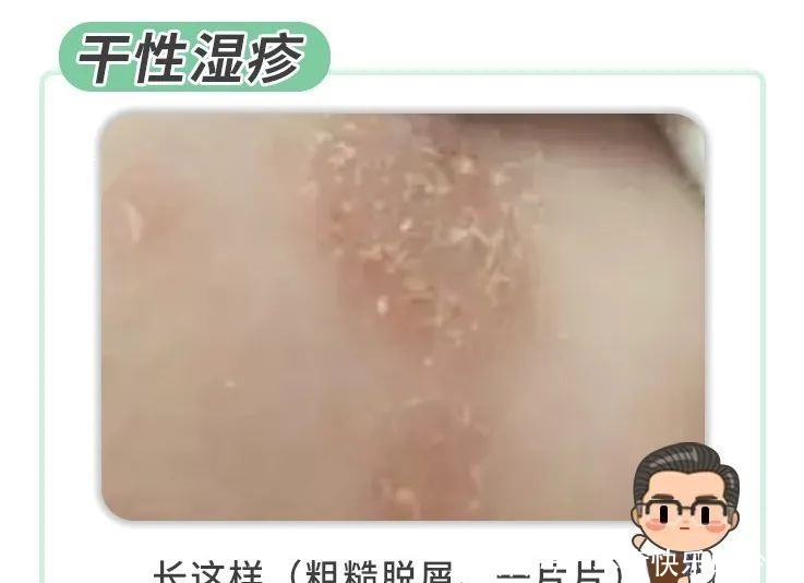 成分|药监局点名!湿疹宝宝霜含禁用成分!这点做不好,再贵的药也没用