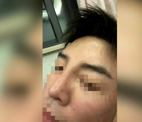 医院 贵阳一男子隆鼻后变“阿凡达”要求退钱遭拒：他术后还做了这些事