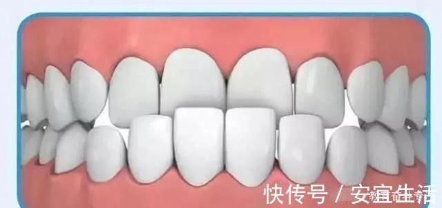 畸形|父母請注意：孩子12歲之前必須矯正的幾種牙齒畸形