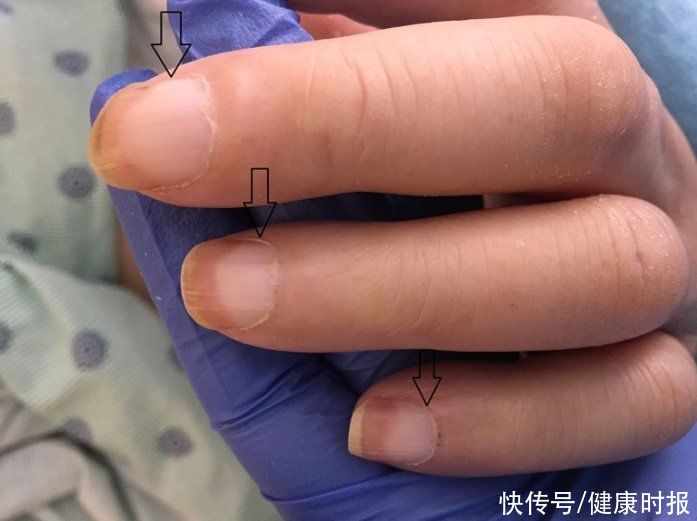 充血性|你的肾好不好,看指甲就知道!医生:指甲长成这样的要小心了