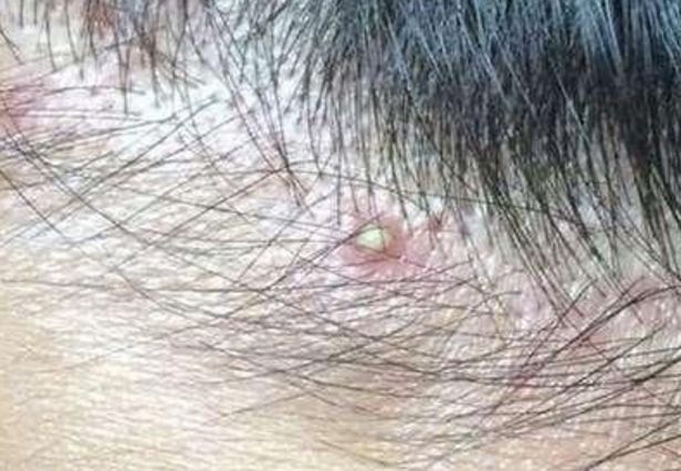 长时间|头皮总起小疙瘩,疼痛难忍专家4大问题需重视,为了健康